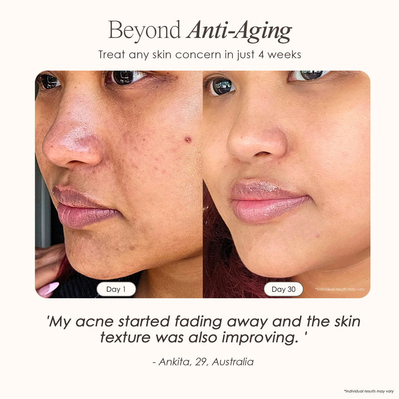 Nuvio Hochfrequenz-Akne-Stab